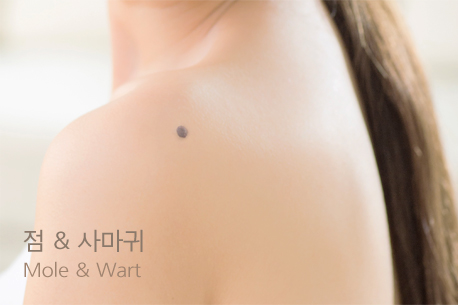 점 & 사마귀 Mole & Wart